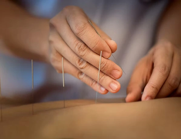 Acupuncture needle close-up - precision placement for Traditional Chinese Medicine treatment and pain relief