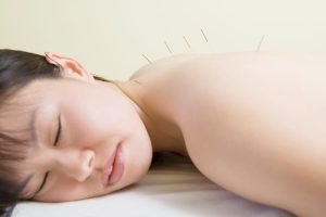 Body acupuncture