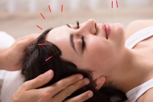 facial acupuncture